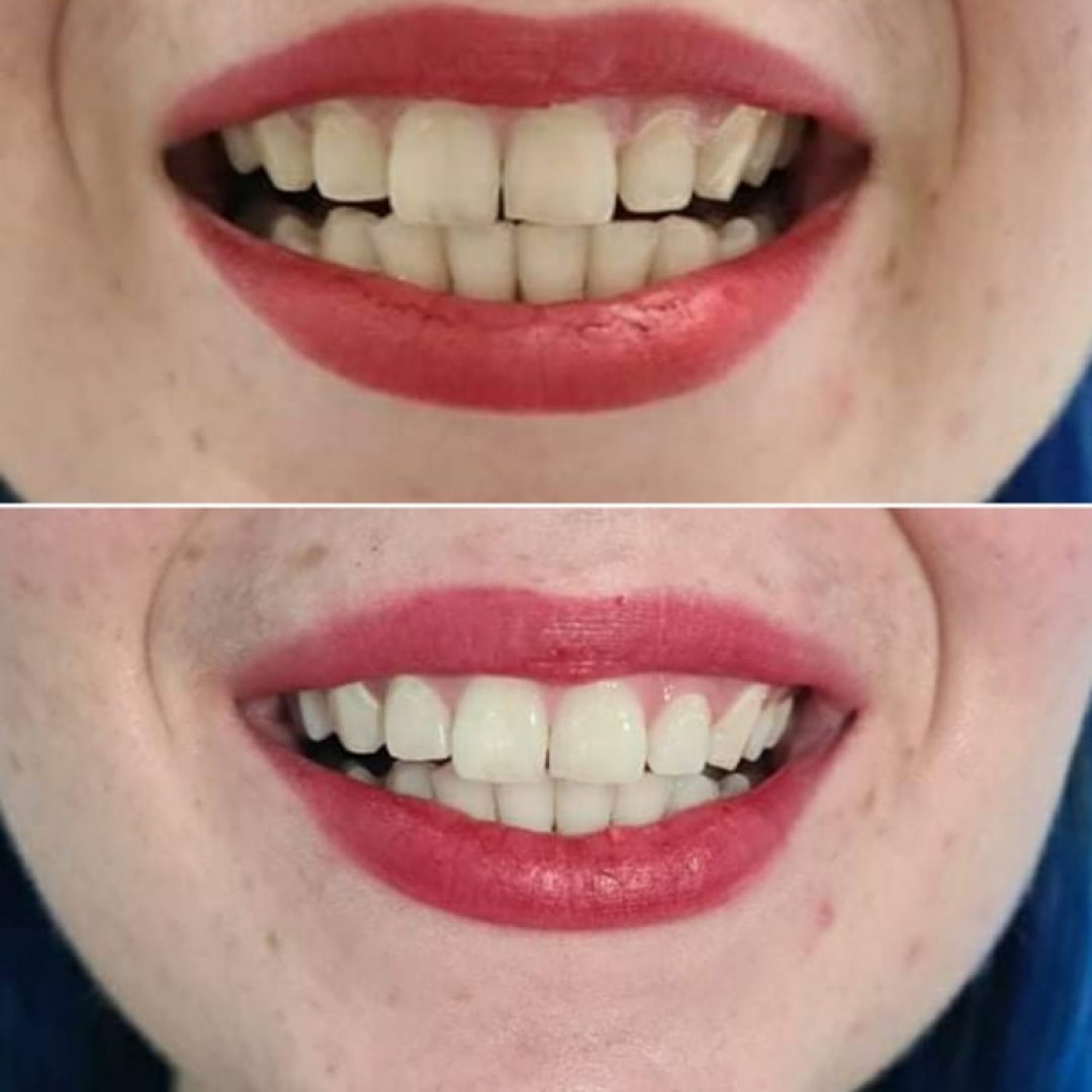 Teeth Whitening Royale Beauty Therapy